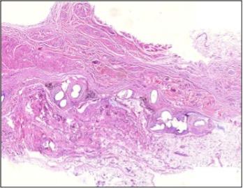 Морфология зоны имплантации синтетических герниопротезов, модифицированных углеродом